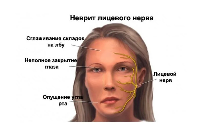Причины, симптомы и лечение воспаления лицевого нерва